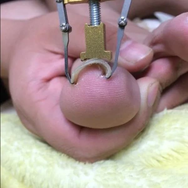 Ingrown toenail correction kit with patches and clips — image 6