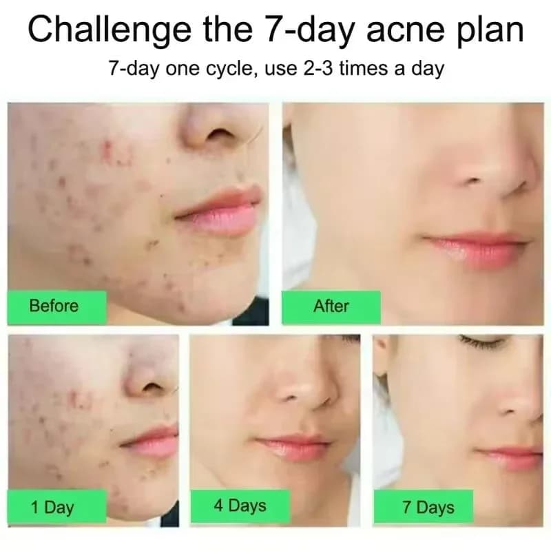 salicylic acid acne face cream tube — image 3