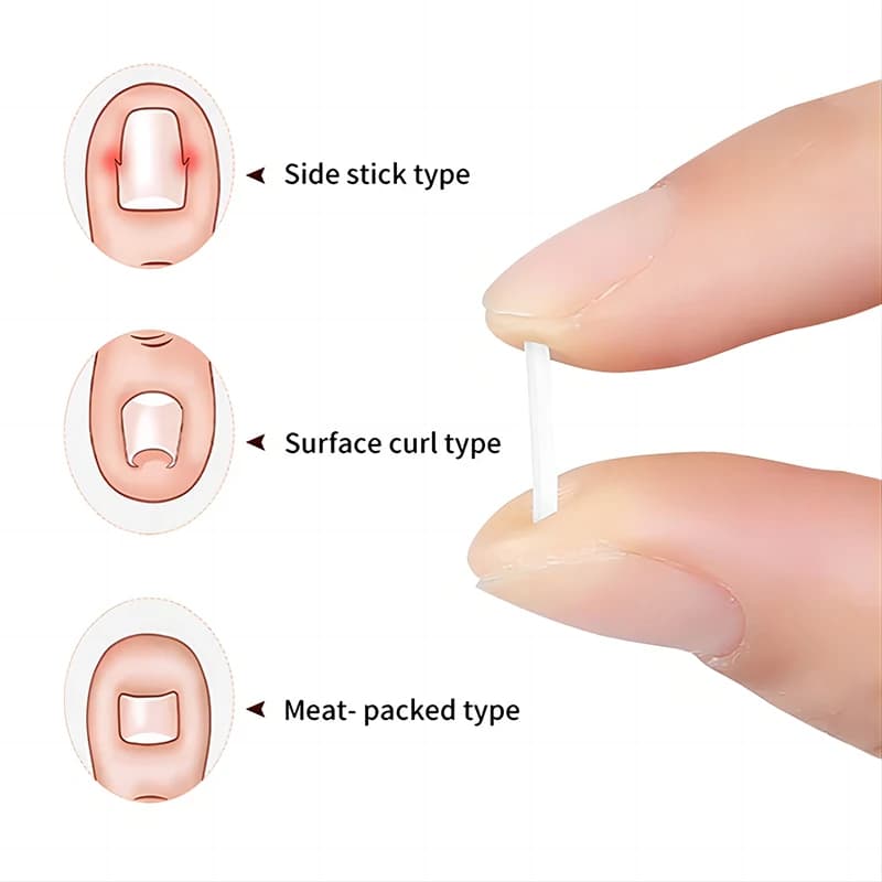 Ingrown toenail correction pad — image 3