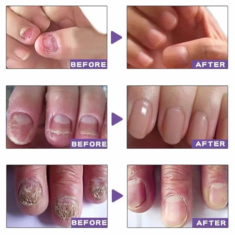 nail fungus treatment serum bottle — image 2