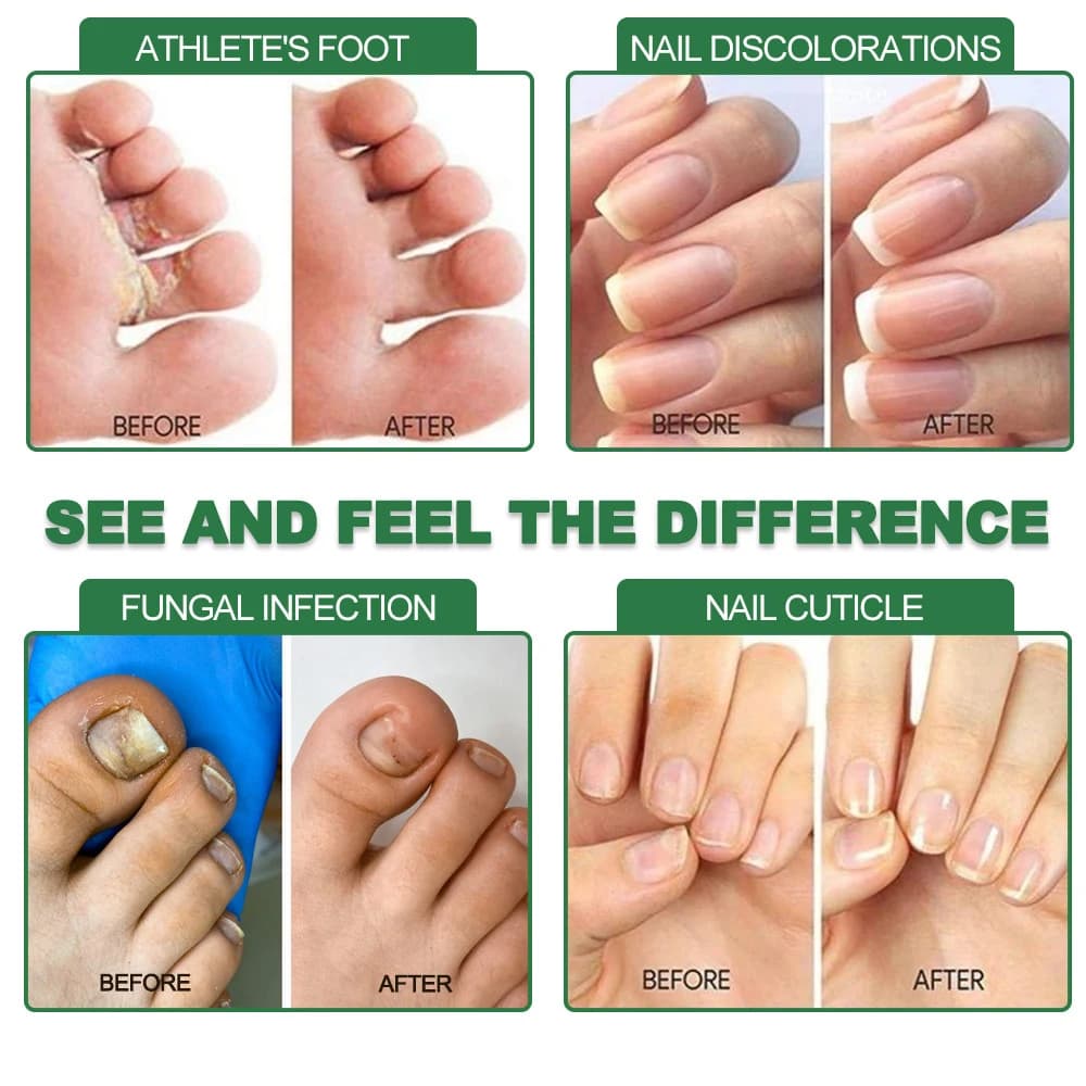 Fungal nail treatment serum bottle — image 2