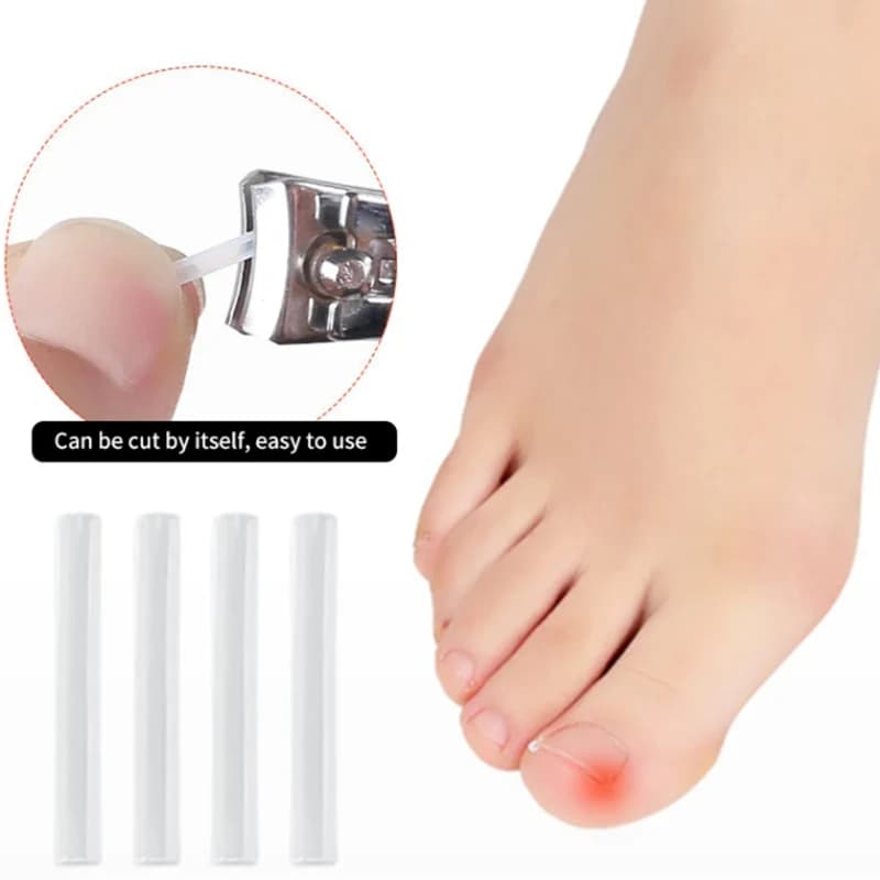 Ingrown toenail correction pad — image 2