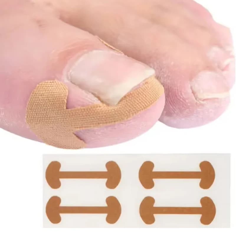 adhesive toenail patch for ingrown nail correction — image 5