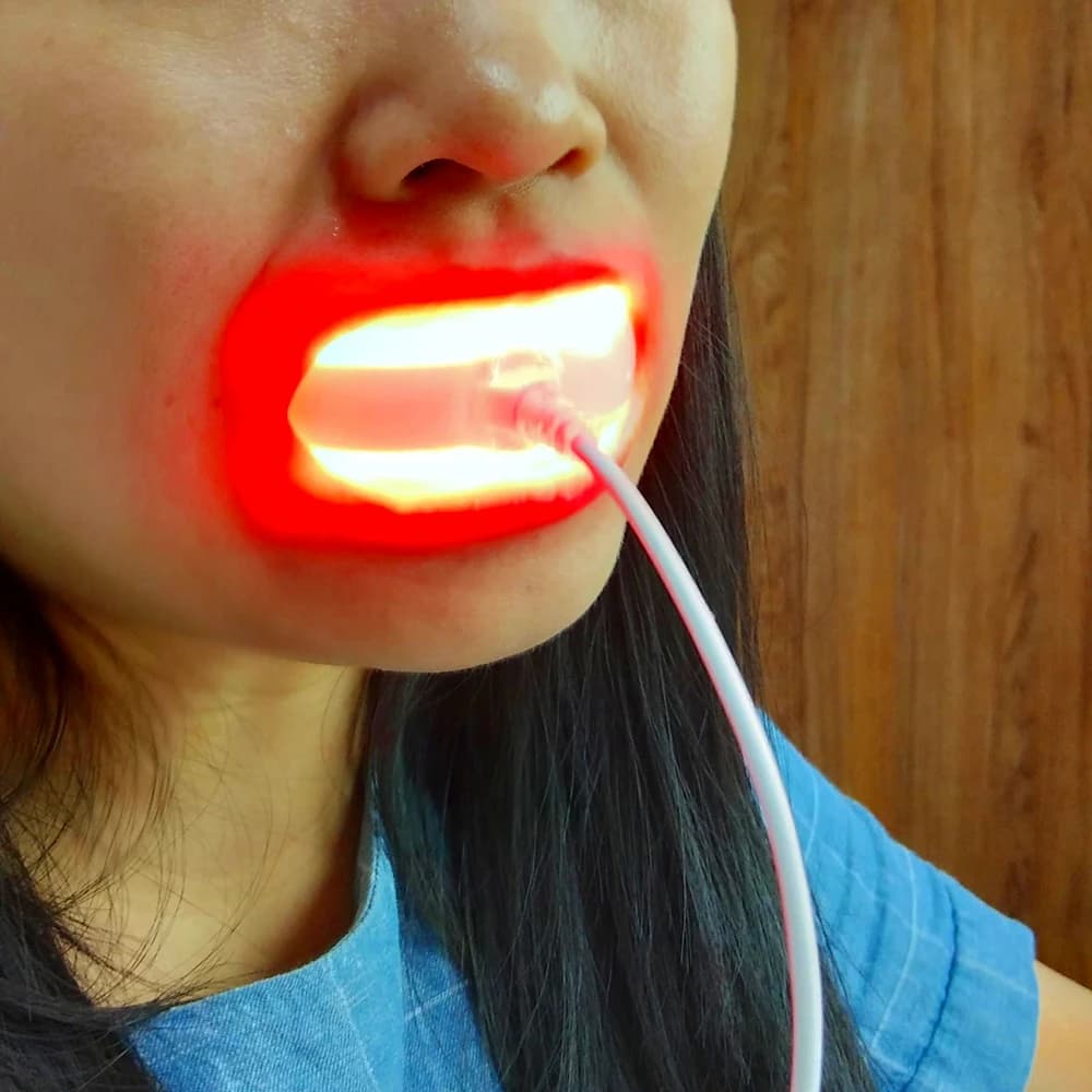 Starlite Smile red light therapy device for gum health — image 7