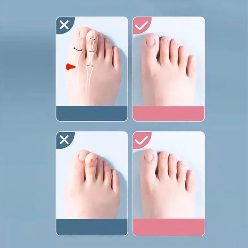 silicone toe separator set two pairs — image 3