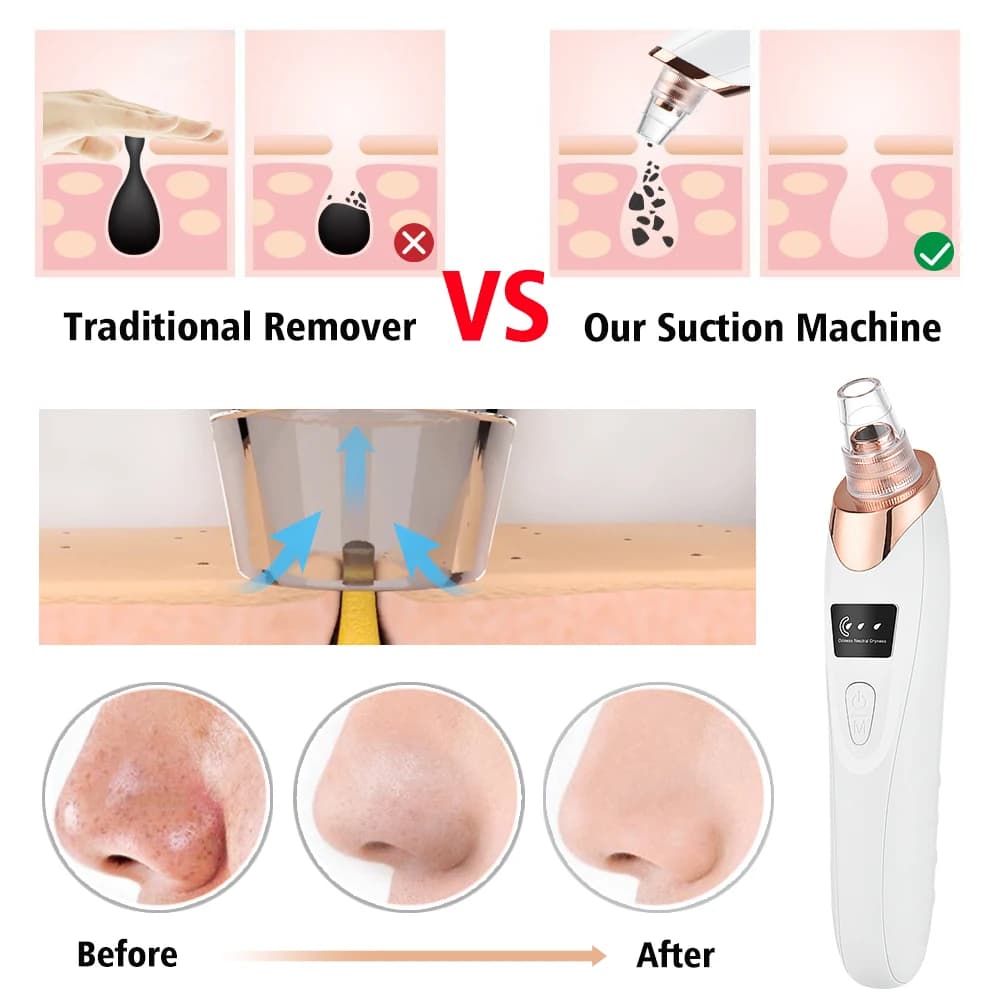 USB rechargeable facial pore vacuum cleaner — image 4