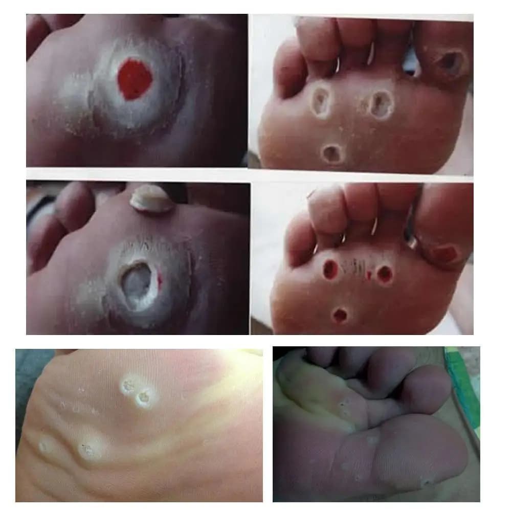 Self‑adhesive toe and foot protector pads — image 5