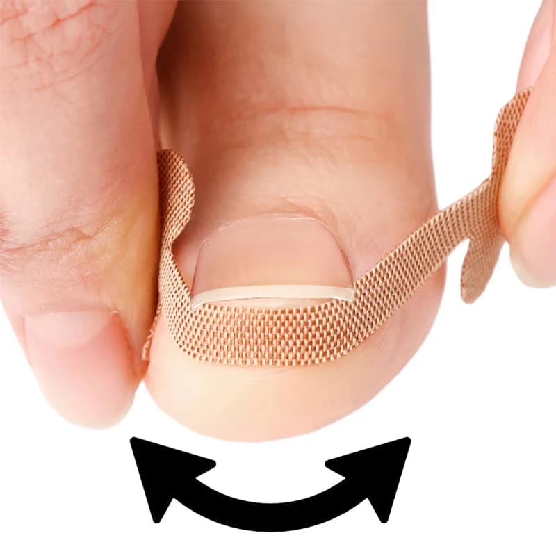 adhesive toenail patch for ingrown nail correction — image 4