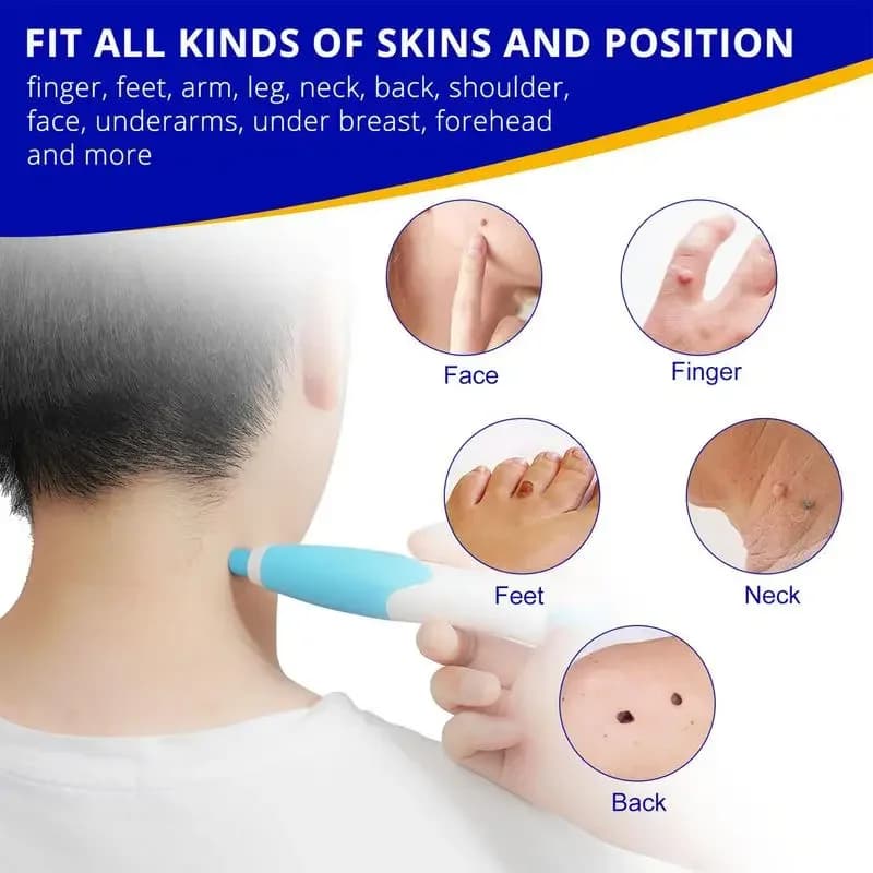 double-headed wart and skin tag remover pen — image 5