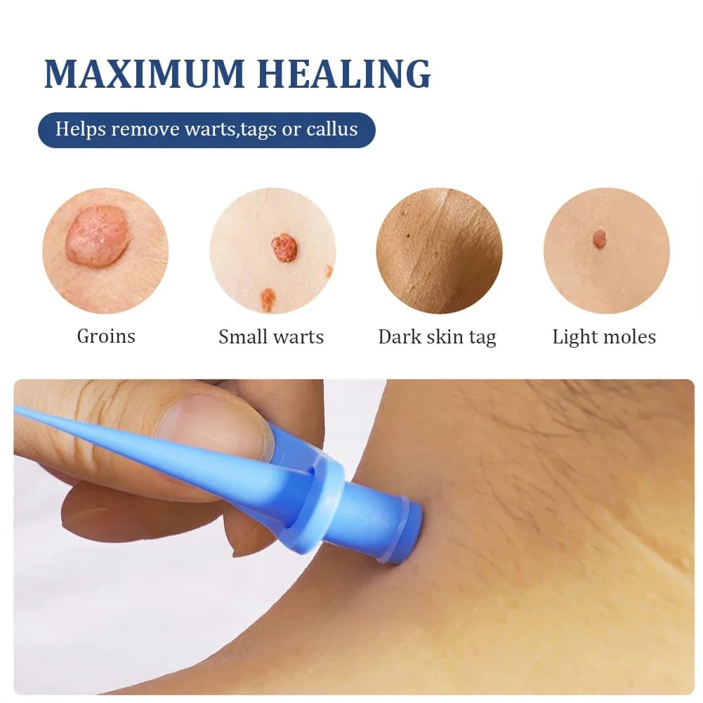 automatic skin tag remover kit — image 6