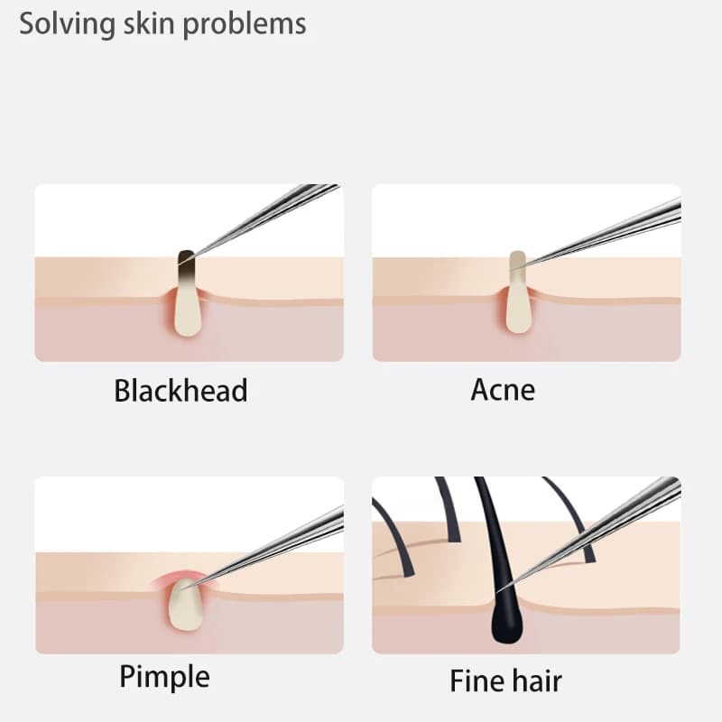 Stainless steel acne and blackhead removal needle — image 5