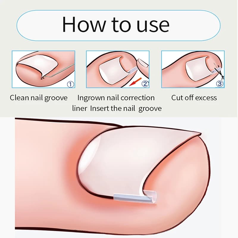 Ingrown toenail correction pad — image 4