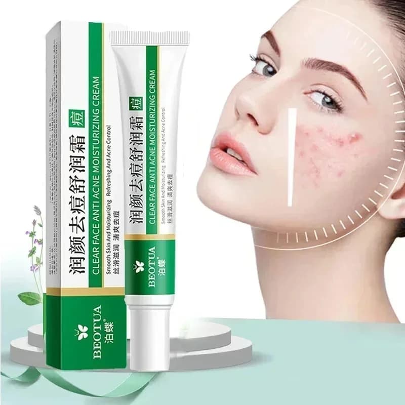 herbal acne treatment cream tube — image 1