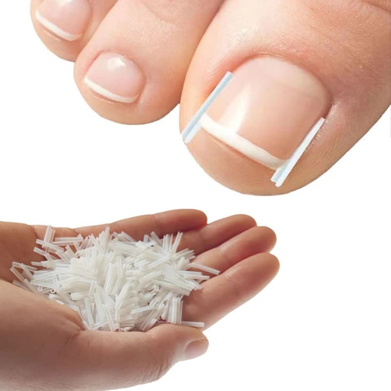 Ingrown toenail correction pad — image 1