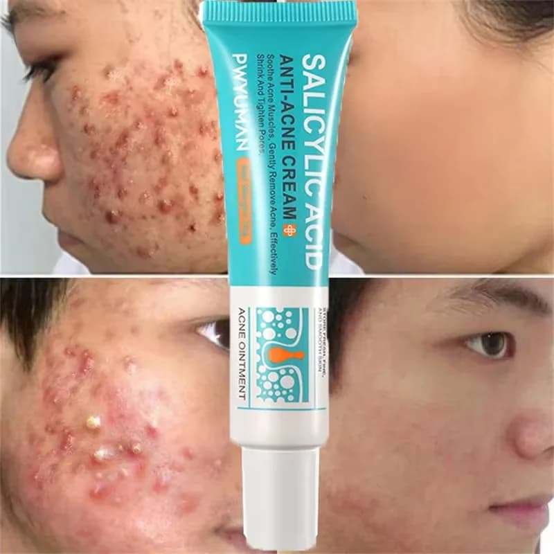 salicylic acid acne face cream tube — image 1