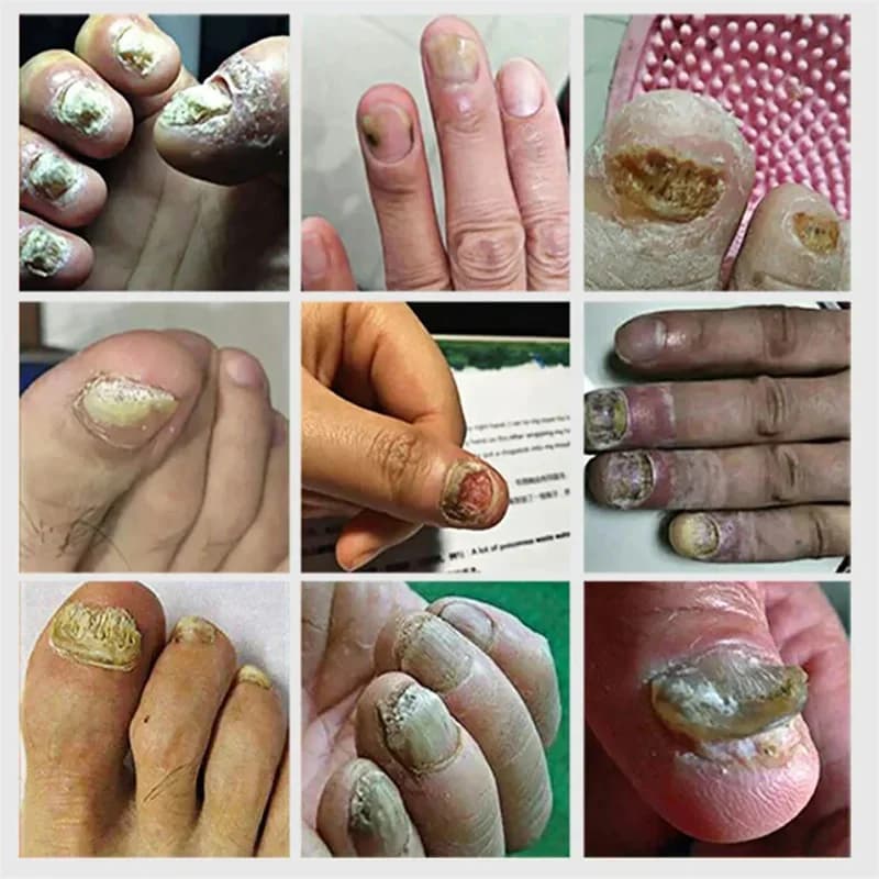 nail fungus treatment serum bottle — image 4