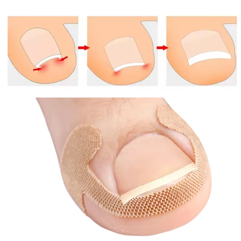 adhesive toenail patch for ingrown nail correction — image 3