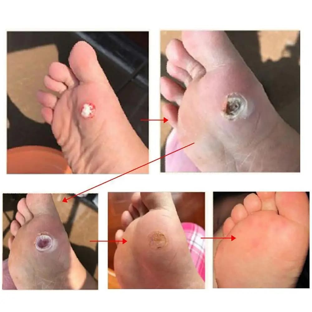 Self‑adhesive toe and foot protector pads — image 4