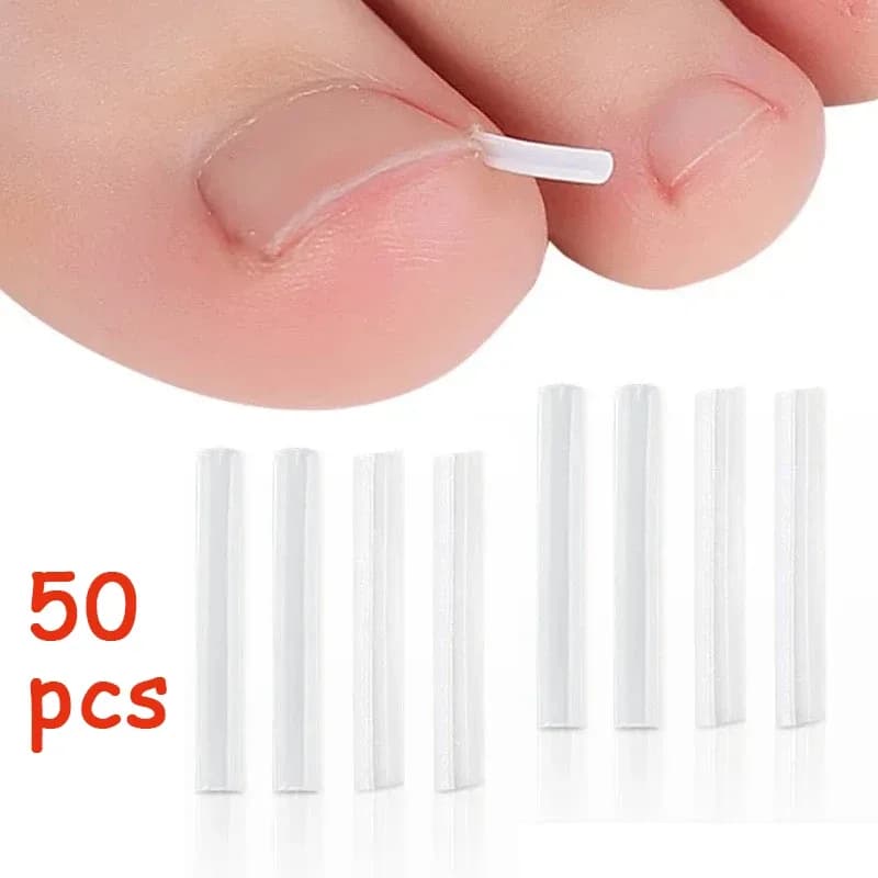 Ingrown Toenail Correction Tool – Pack of 50