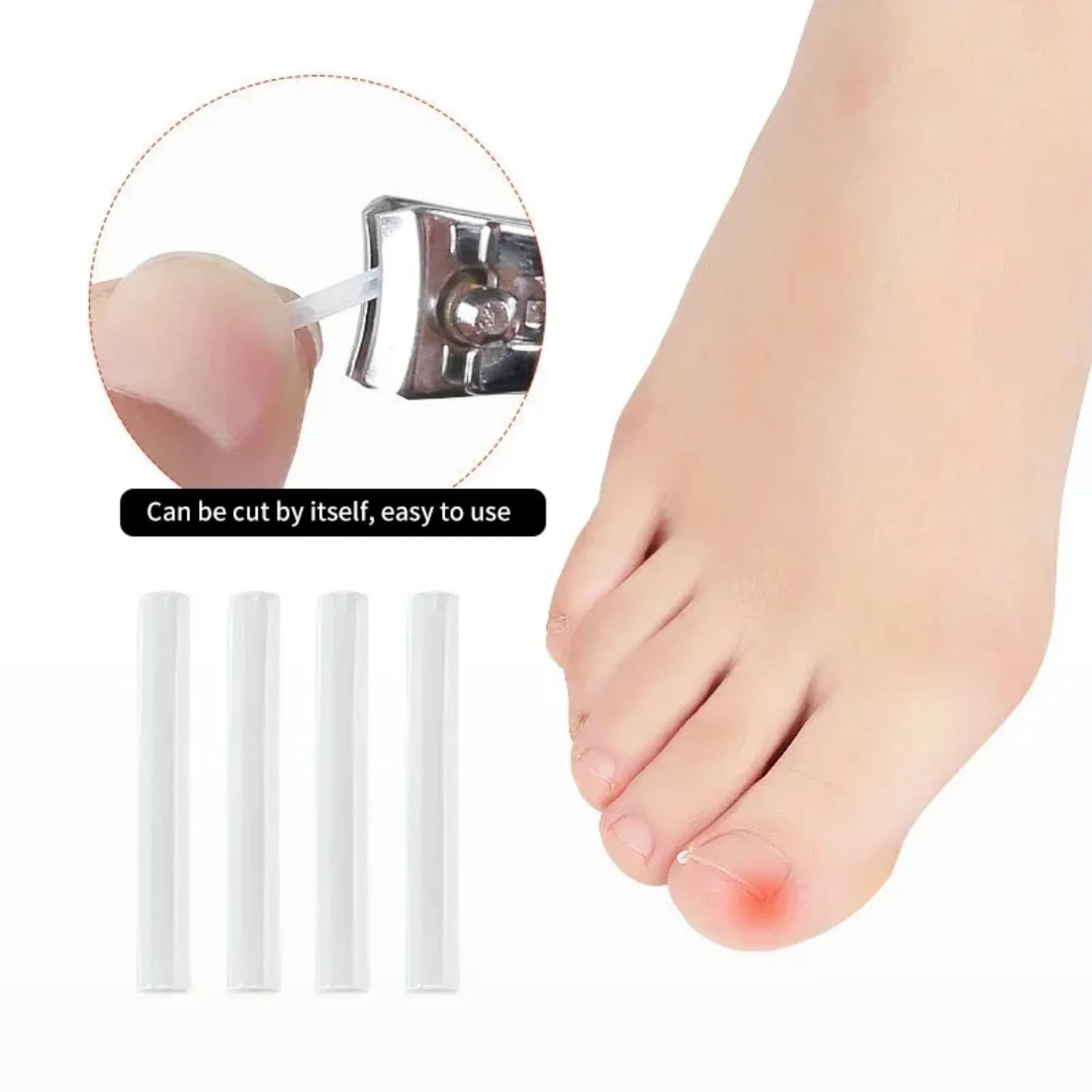 set of 50 elastic ingrown toenail clips — image 4