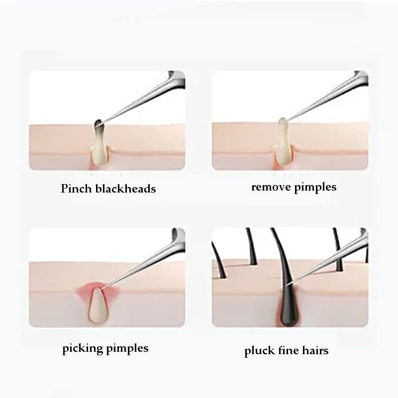 Ingrown hair tweezers with multiple needle tips — image 5