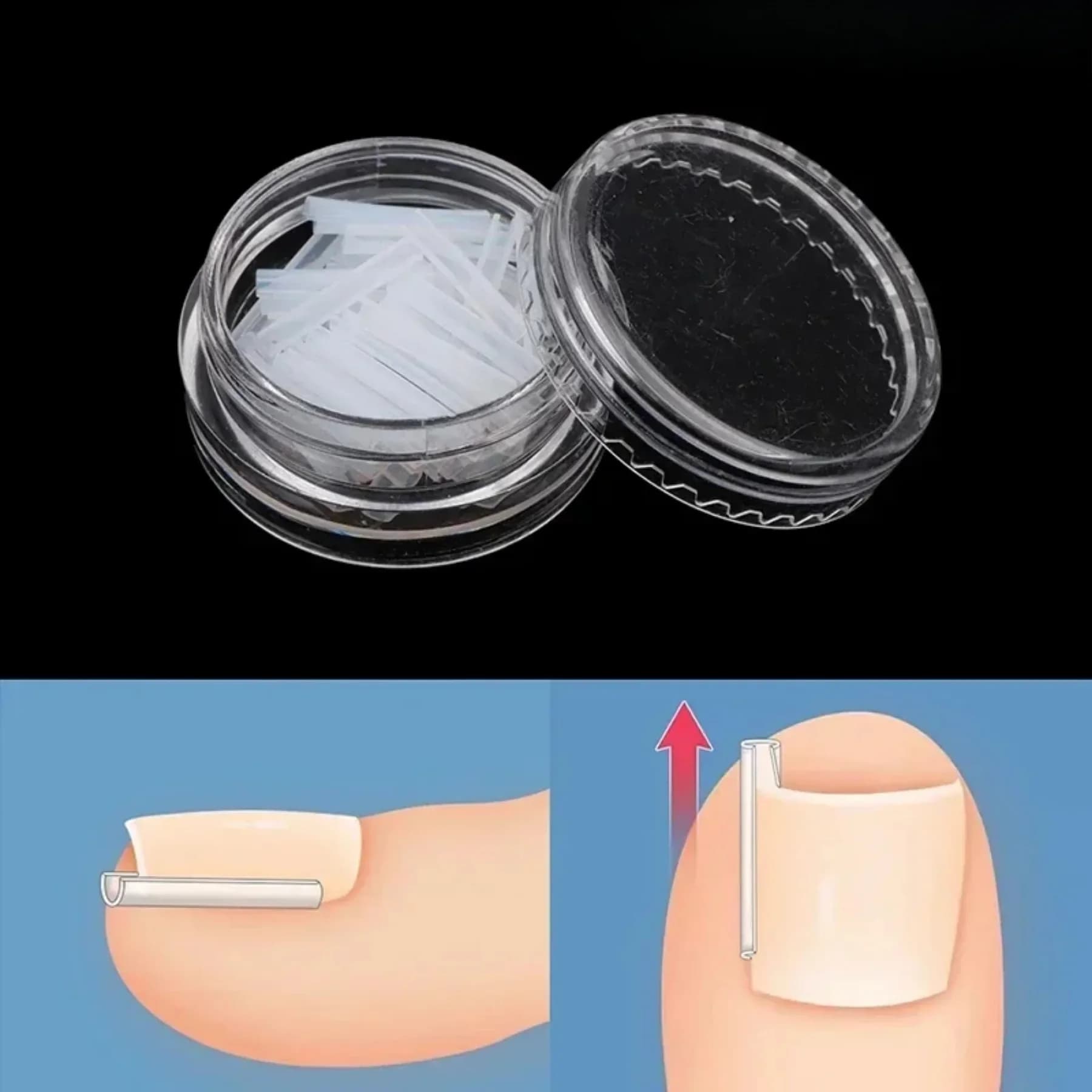 set of 50 elastic ingrown toenail clips — image 3