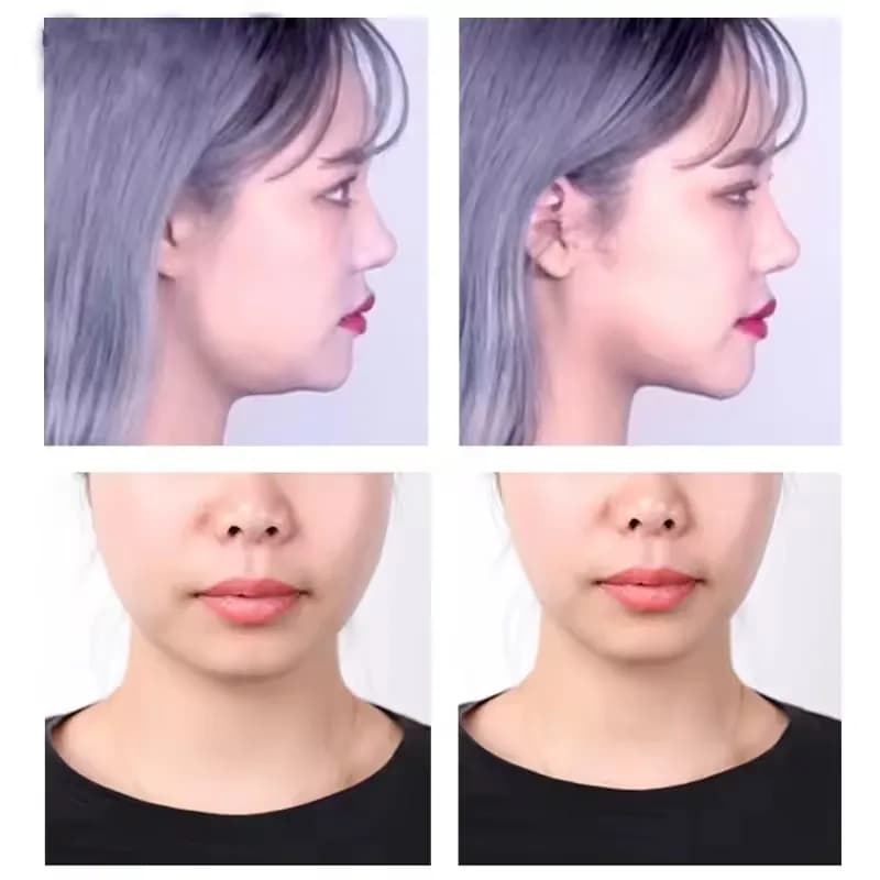 V-shape transparent face lifting adhesive tape — image 4