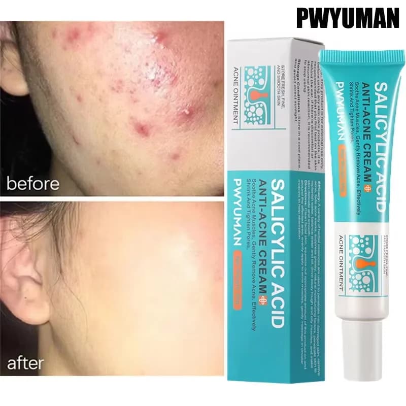 salicylic acid acne face cream tube — image 2