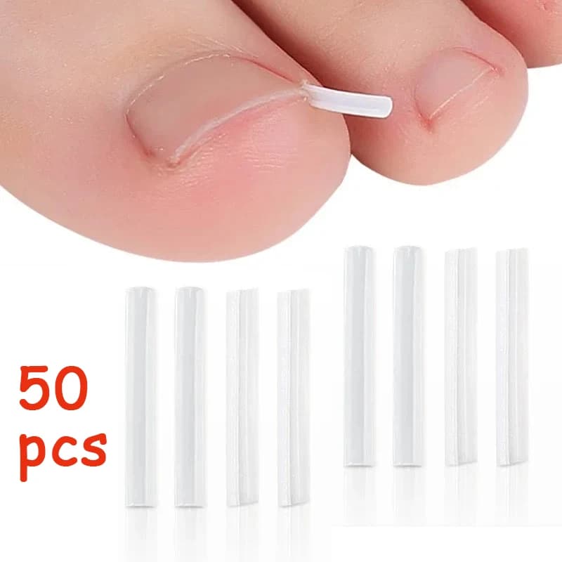 Ingrown Toenail Correction Tool – Pack of 50