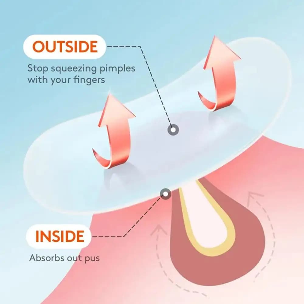 hydrocolloid acne patches with salicylic acid and tea tree oil — image 4