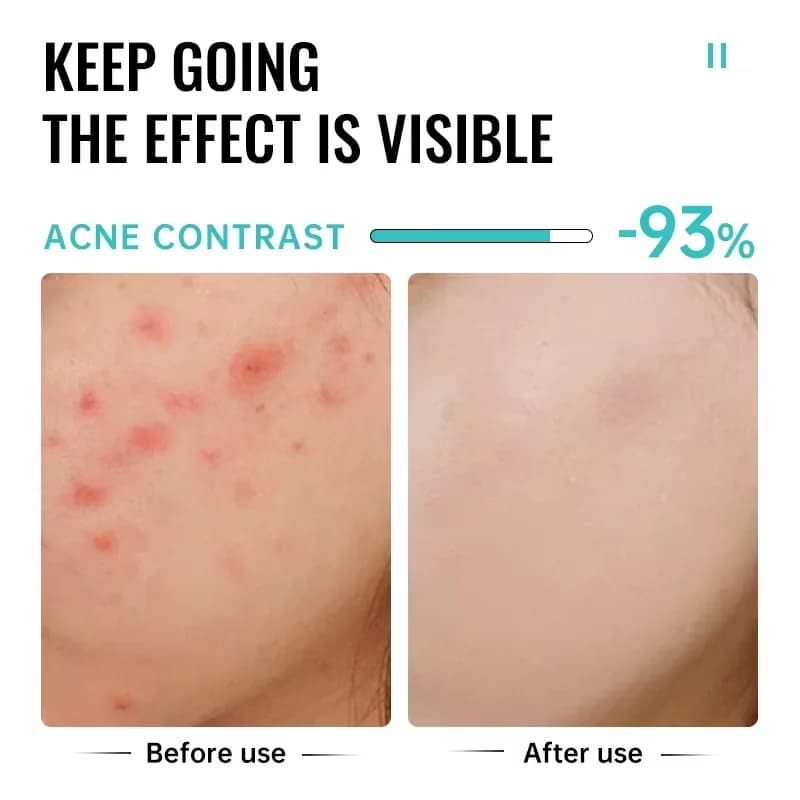 salicylic acid acne face cream tube — image 4
