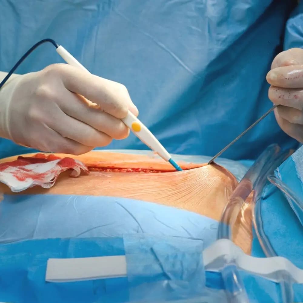 tungsten active electrode for high‑frequency electrocautery — image 6